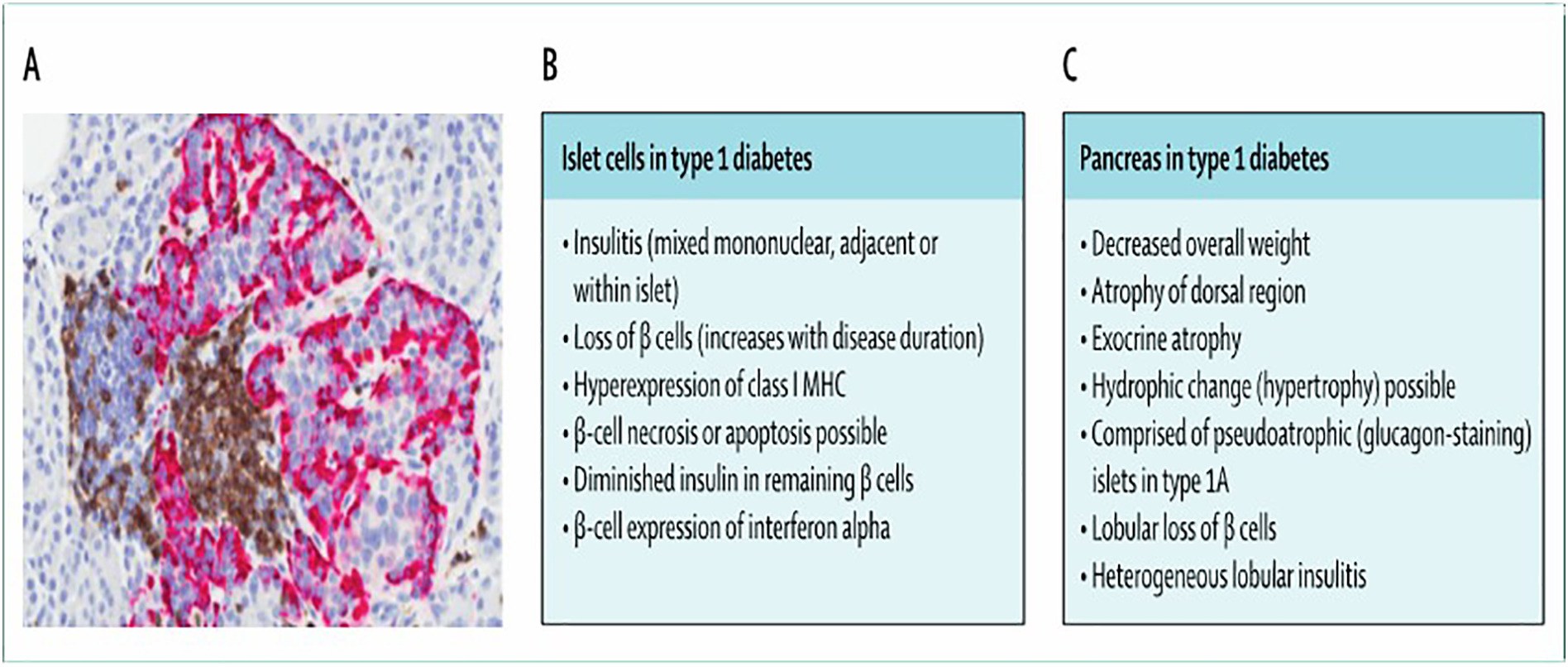 1型糖尿病胰腺的病理特征
