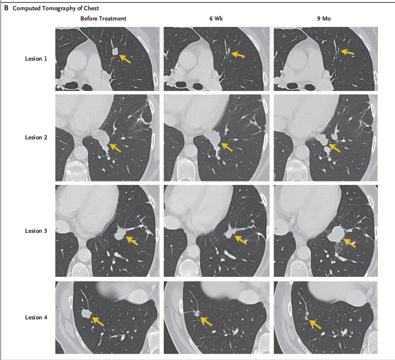 圖2?患者轉移病灶的變化情況