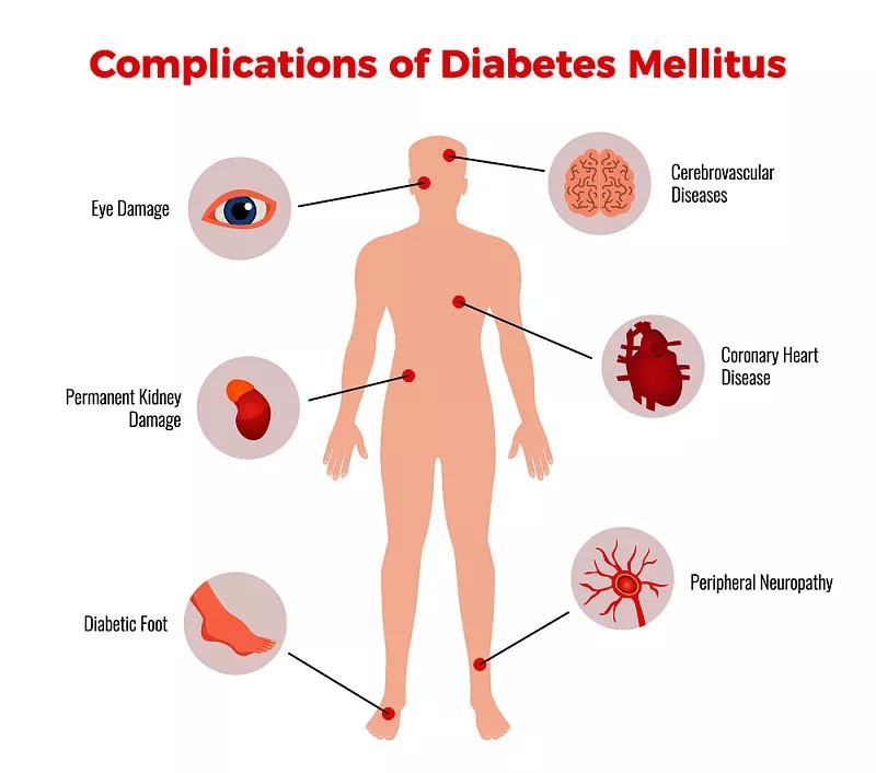 間充質干細胞在治療糖尿病及并發癥的臨床應用潛力 間充質干細胞在治療糖尿病及并發癥的臨床應用潛力