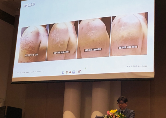 韓國Miracell在國際美容整形外科宣布用干細胞療法治愈銀屑病