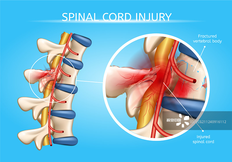 神經(jīng)干細胞移植在脊髓損傷修復(fù)中的作用及應(yīng)用