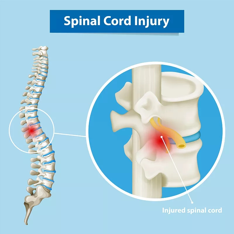 神經干/祖細胞移植治療慢性脊髓損傷的臨床研究進展