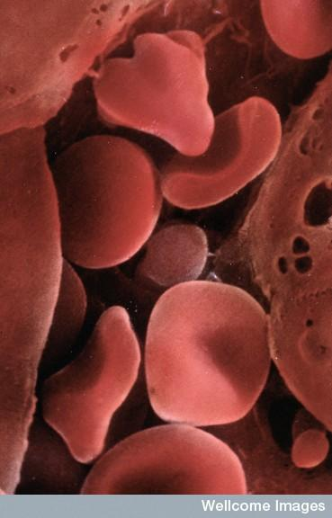 許多血液疾病已經(jīng)可以使用臍帶血進(jìn)行治療。