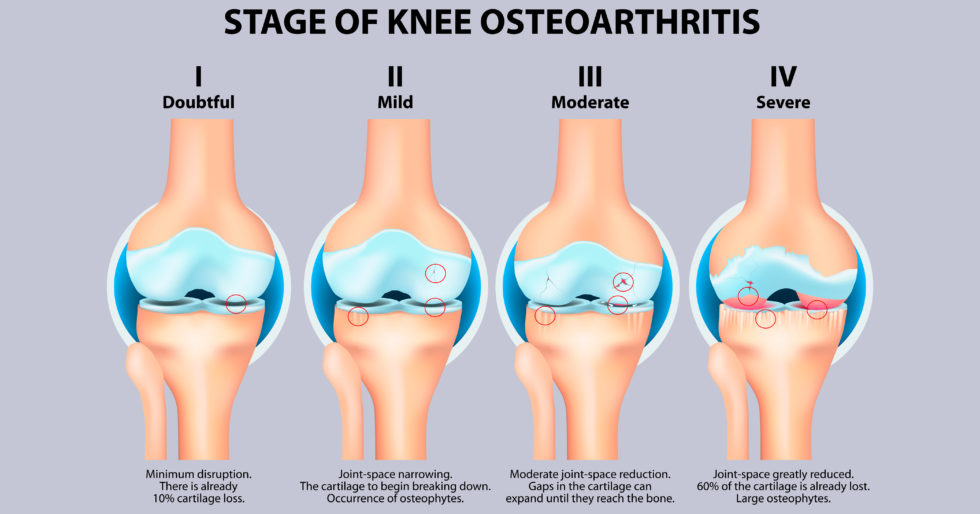 骨關節炎癥狀有哪些