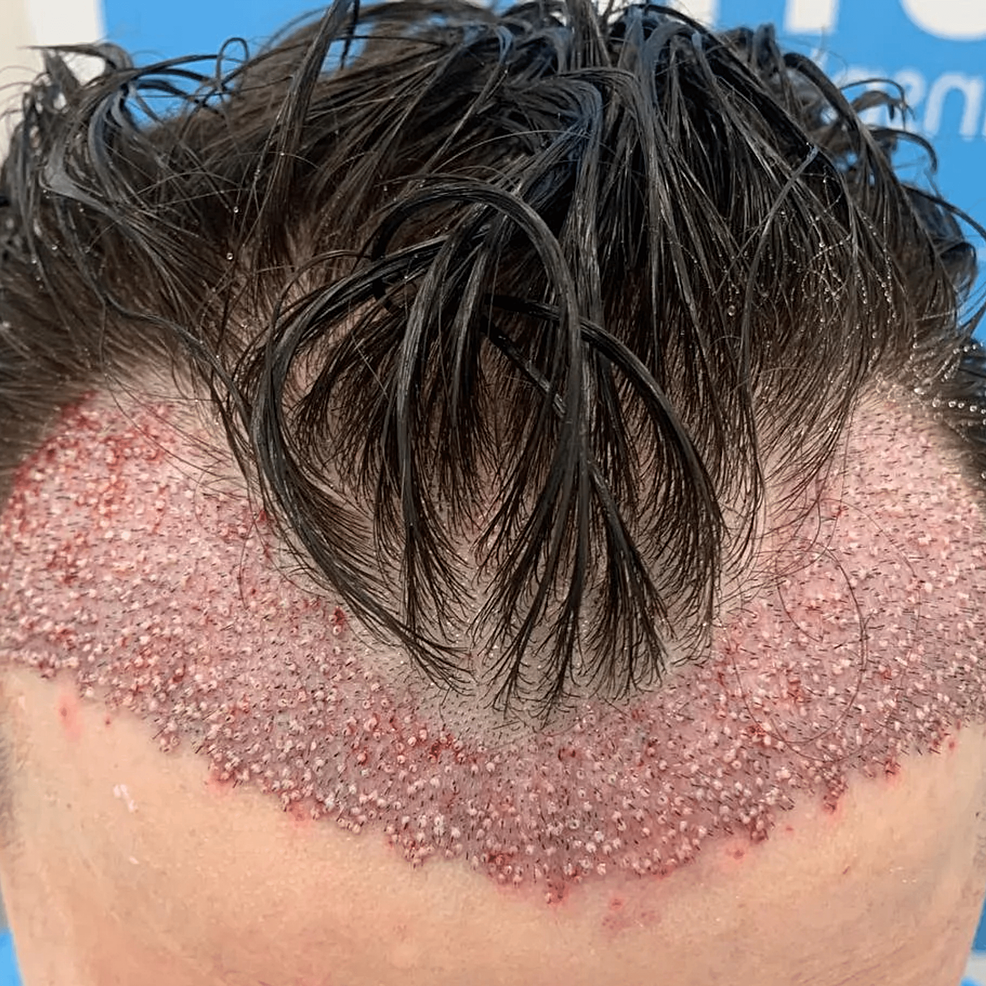 頭發(fā)移植手術(shù)后即刻的結(jié)果。——這允許在患者中建立更豐滿和更前的發(fā)際線 頭發(fā)移植手術(shù)后即刻的結(jié)果。——這允許在患者中建立更豐滿和更前的發(fā)際線