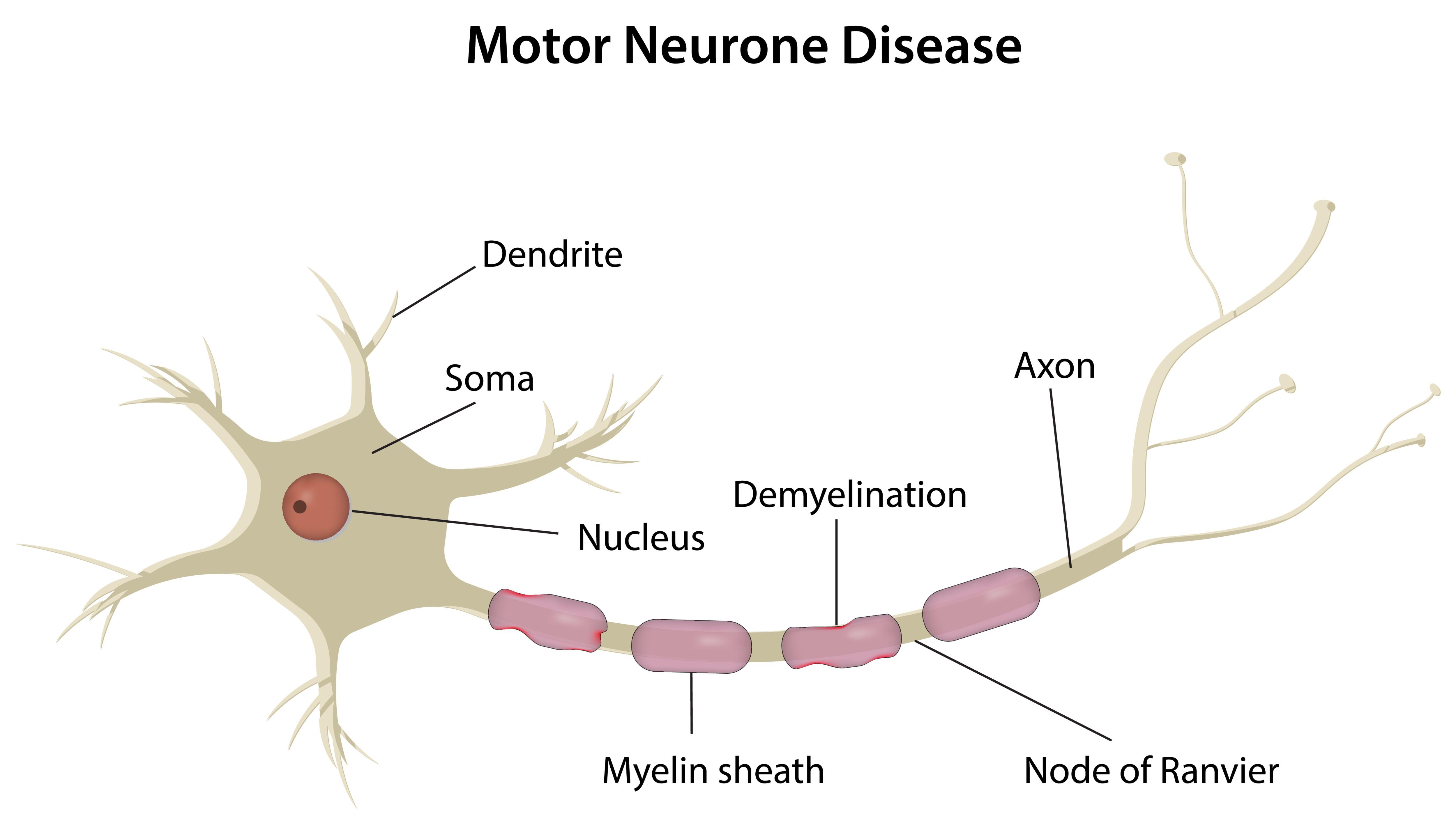 什么是運動神經(jīng)元病？