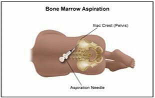 從骨髓中分離干細胞 從骨髓中分離干細胞