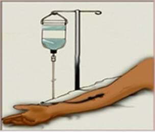 靜脈注射圖像。 靜脈注射圖像。