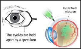 玻璃體內輸注 玻璃體內輸注