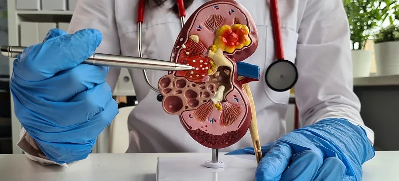 狼瘡的治療方法有哪些？