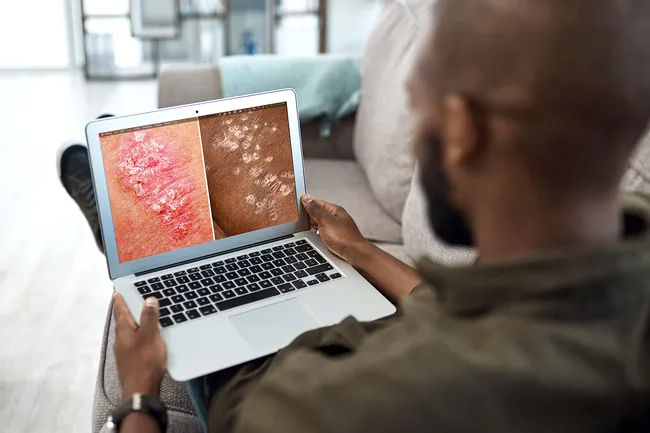 銀屑病的癥狀、類型和原因 銀屑病的癥狀、類型和原因