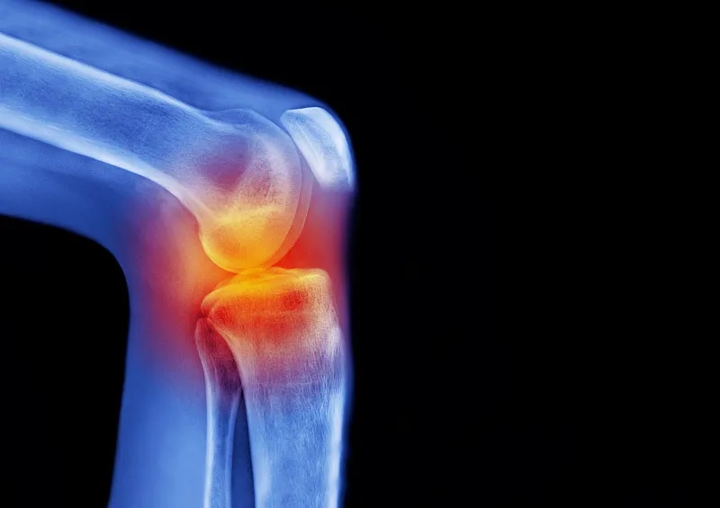 骨關(guān)節(jié)炎——間充質(zhì)干細(xì)胞在軟骨再生中的作用 骨關(guān)節(jié)炎——間充質(zhì)干細(xì)胞在軟骨再生中的作用