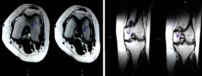 圖2：治療后MRI顯示內(nèi)側(cè)和外側(cè)半月板后角的撕裂有所改善。患者經(jīng)歷了癥狀改善以及進(jìn)行日常生活活動(dòng)的能力增強(qiáng)。