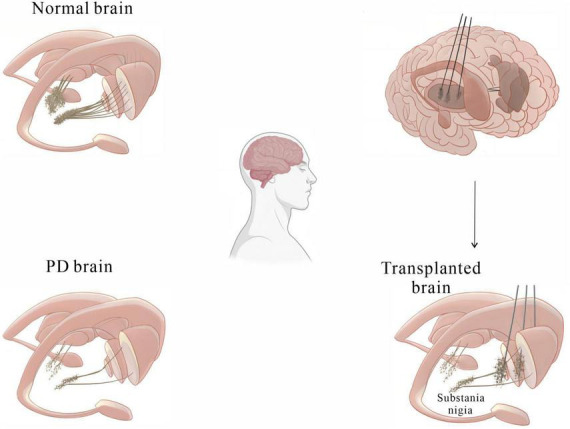 圖2：基本圖顯示細(xì)胞移植療法如何緩解帕金森病患者的運(yùn)動癥狀。
