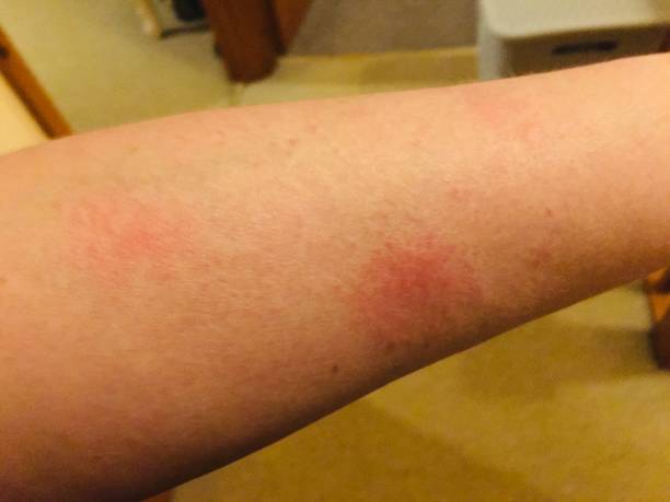 系統性紅斑狼瘡的最佳治療方法是什么？