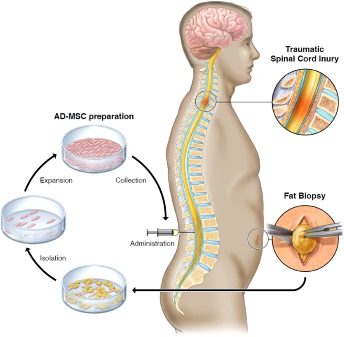 通過(guò)活檢、AD-MSC 分離、擴(kuò)增和收集以及治療管理來(lái)獲取脂肪的過(guò)程圖解