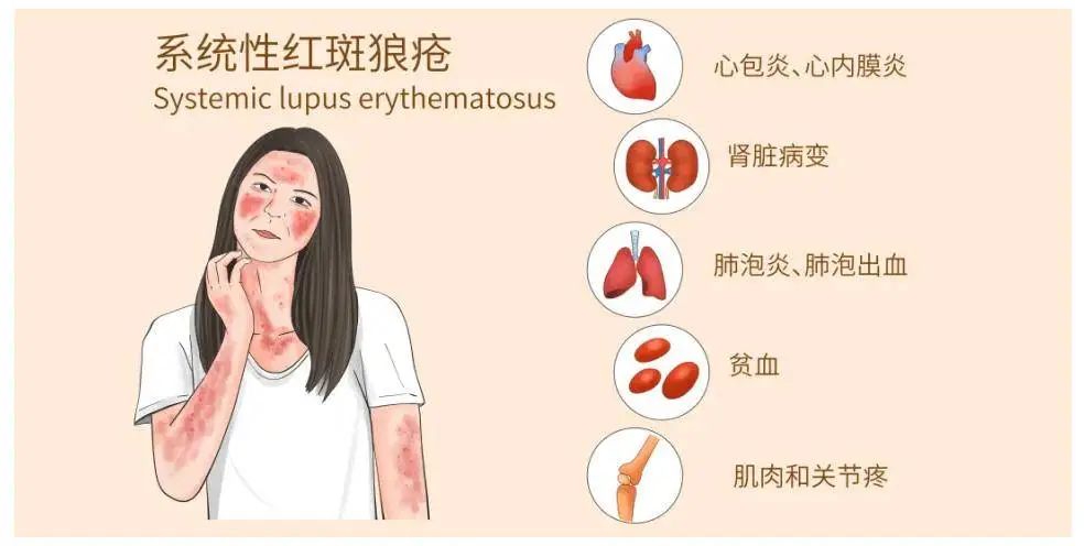 什么是系統性紅斑狼瘡? 什么是系統性紅斑狼瘡?