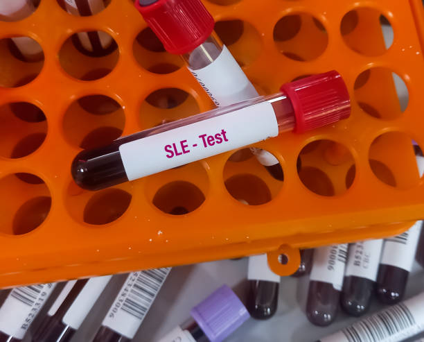 干細(xì)胞移植治療系統(tǒng)性紅斑狼瘡的臨床療效分析 干細(xì)胞移植治療系統(tǒng)性紅斑狼瘡的臨床療效分析