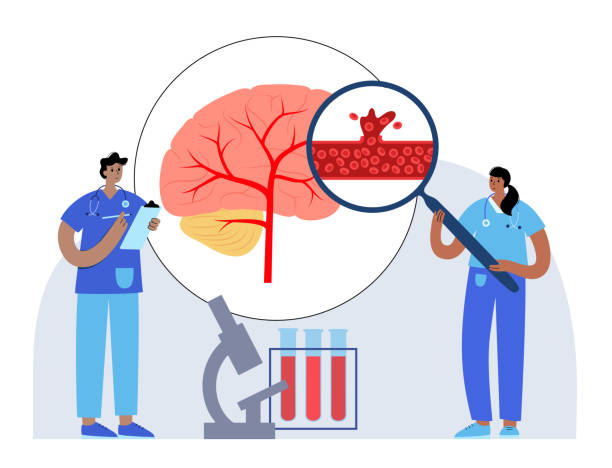 圍產(chǎn)期中風-類型、原因和風險因素