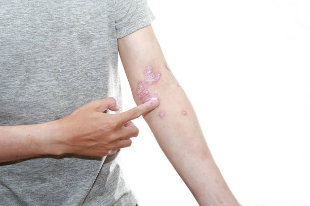 預防銀屑病發作的10個技巧，你都了解嗎？