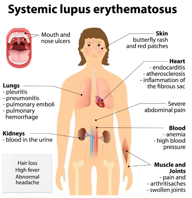 什么是系統性紅斑狼瘡?干細胞治療系統性紅斑狼瘡的臨床案例有哪些? 什么是系統性紅斑狼瘡?干細胞治療系統性紅斑狼瘡的臨床案例有哪些?