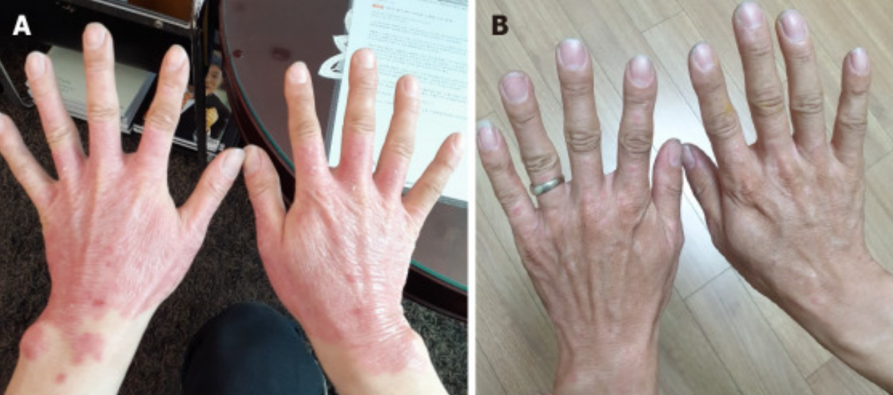 3次干細胞治療后25年?銀屑病頑疾得到顯著改善! 3次干細胞治療后25年?銀屑病頑疾得到顯著改善!