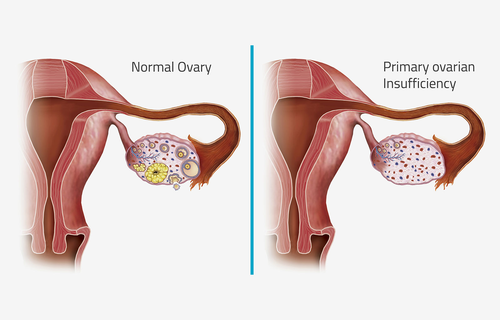 正常卵巢與患上卵巢早衰之后的卵巢對比