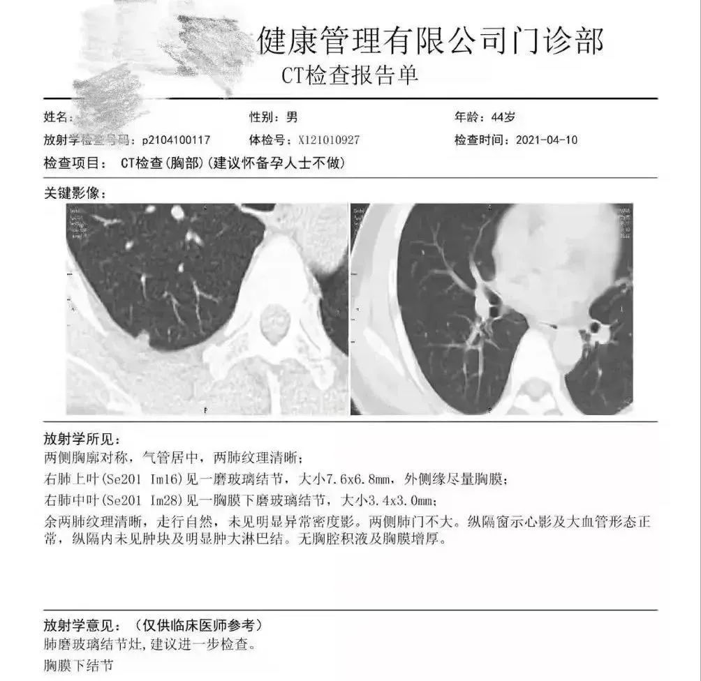 結果發現王先生右肺胸膜表面下（肺的內部），存在兩枚磨玻璃結節，其中較大者直徑7.6mm。