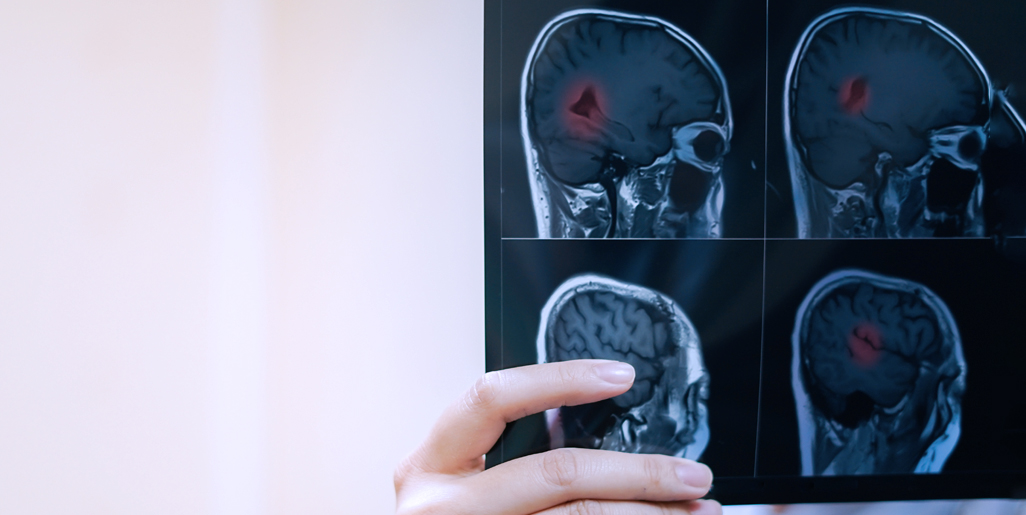 多發(fā)性硬化癥的干細胞療法：探索神經(jīng)免疫學(xué)的新前沿