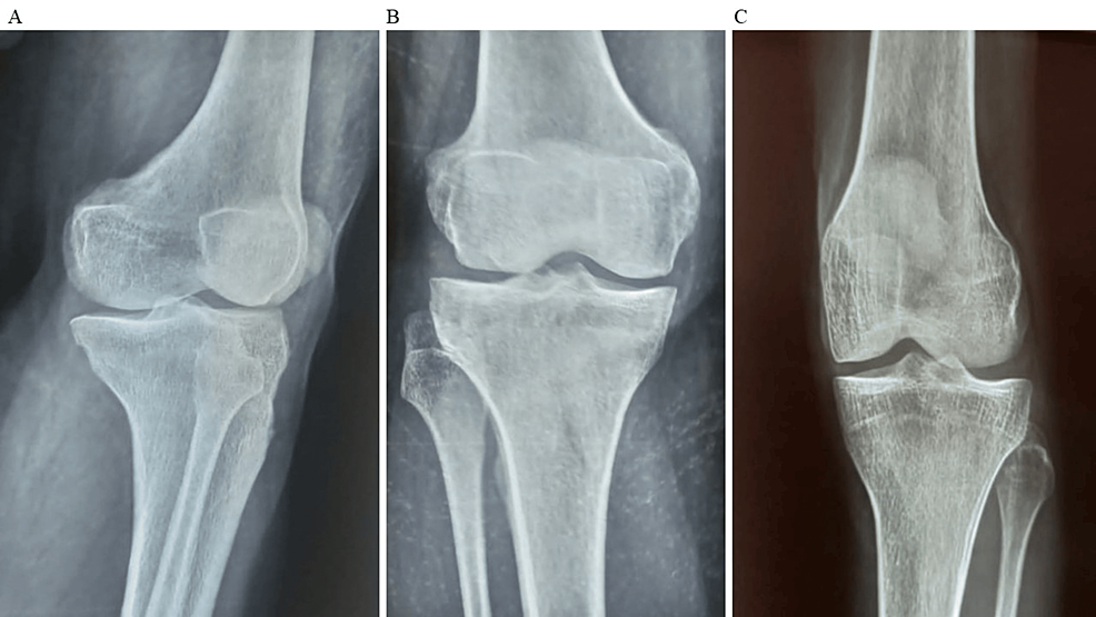 圖2：顯示了開始干細(xì)胞治療后骨骼的側(cè)視圖和前后視圖