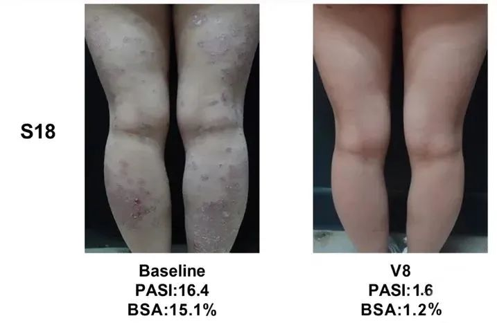總共47.1% (8/17)的銀屑病患者在PASI（皮損面積和嚴(yán)重程度）評(píng)分中有至少40%的改善