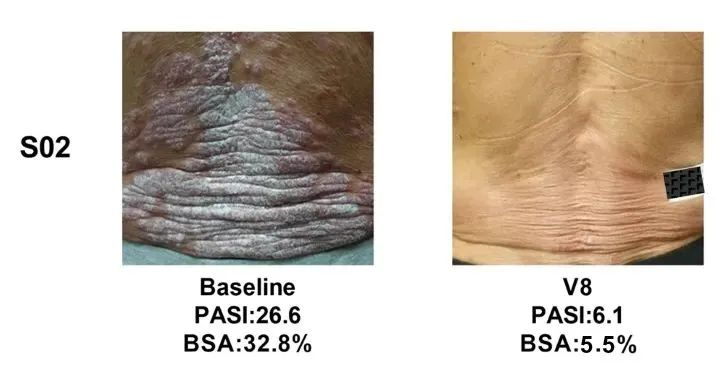 總共47.1% (8/17)的銀屑病患者在PASI（皮損面積和嚴(yán)重程度）評(píng)分中有至少40%的改善