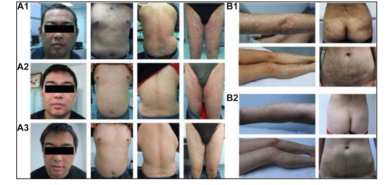 兩例尋常型銀屑病患者通過臍帶間充質干細胞（UC-MSCs）治療，兩例患者均在4至5年內未復發。