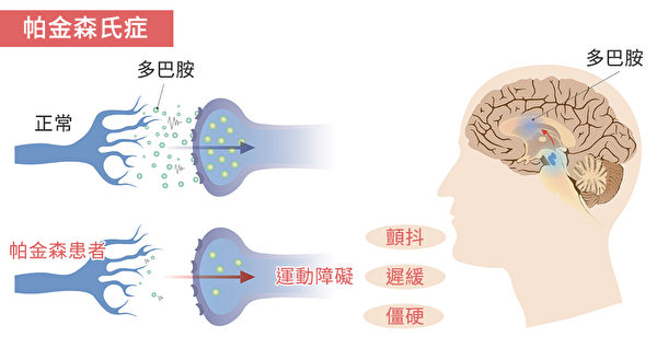 帕金森病 (PD) 的常見(jiàn)癥狀