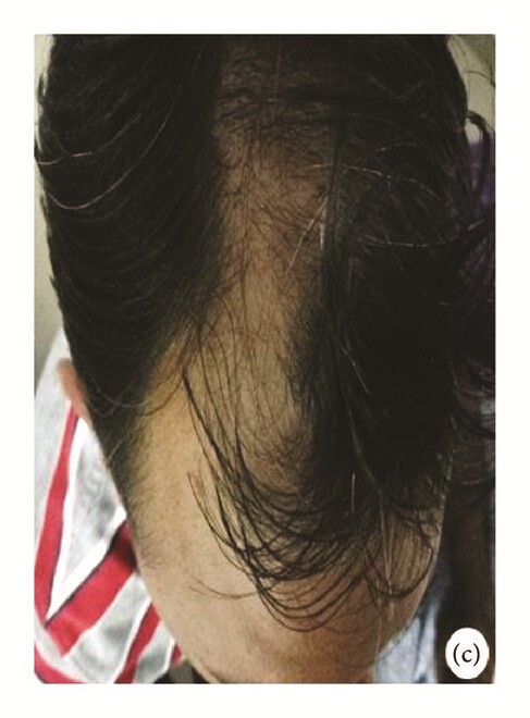 局部應(yīng)用骨髓間充質(zhì)干細(xì)胞一個月后，銀屑病消退，炎性紅斑完全清除（c）。