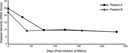 圖 1?. 移植 MSCs 前后兩例患者的銀屑病面積和嚴重程度指數 (PASI) 評分總結。在輸注 MSCs 后的隨訪中,每例患者的 PASI 評分均有所下降。評分由第三方皮膚科醫生進行。臨床改善持久,患者 A 的改善持續超過 150 天,患者 B 的改善持續超過 200 天。 圖 1?. 移植 MSCs 前后兩例患者的銀屑病面積和嚴重程度指數 (PASI) 評分總結。在輸注 MSCs 后的隨訪中,每例患者的 PASI 評分均有所下降。評分由第三方皮膚科醫生進行。臨床改善持久,患者 A 的改善持續超過 150 天,患者 B 的改善持續超過 200 天。