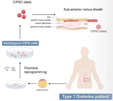 干細胞技術將成為糖尿病治療的新里程碑 干細胞技術將成為糖尿病治療的新里程碑