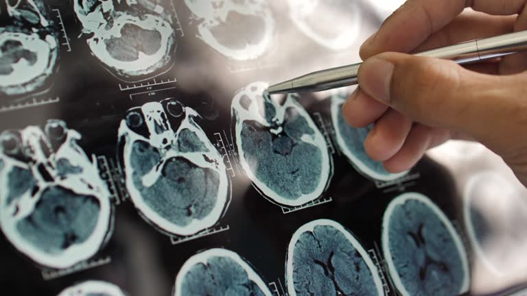 事關神經退行性疾病，干細胞在治療神經退行性疾病的療效、倫理、安全等問題的綜述