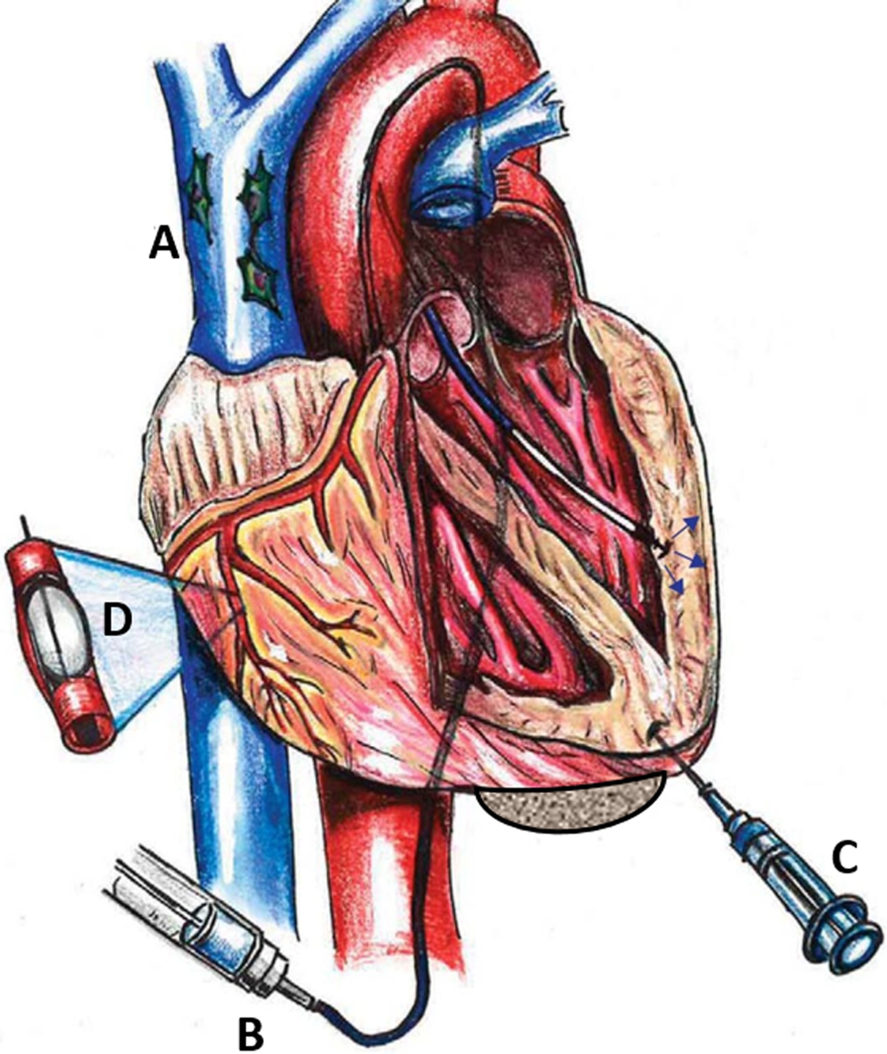 圖1：MSC通過(guò)系統(tǒng) (Sys) 和局部 (Loc) 途徑進(jìn)入心臟。