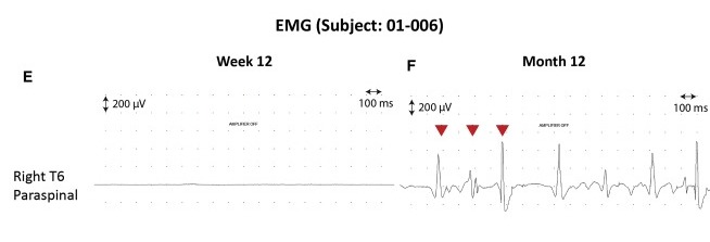 圖3：患者2腦運(yùn)動(dòng)控制評估(BMCA)和EMG評估