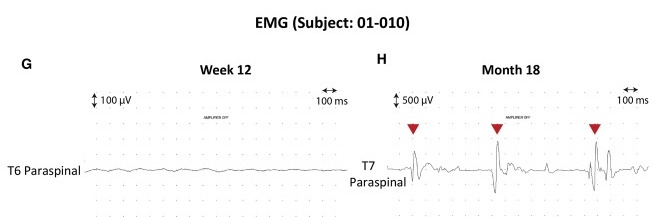 圖4：患者4腦運(yùn)動(dòng)控制評估(BMCA)和EMG評估