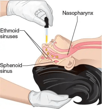 干細(xì)胞輸送方法有13種，其中干細(xì)胞移植的過程都是什么樣的？