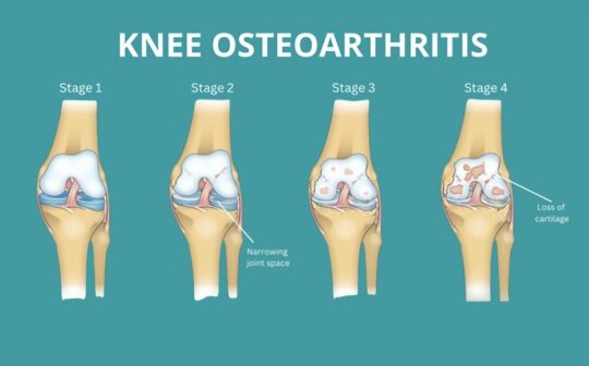 干細(xì)胞治療膝骨關(guān)節(jié)炎：患者臨床癥狀顯著改善，減少炎癥，消除疼痛