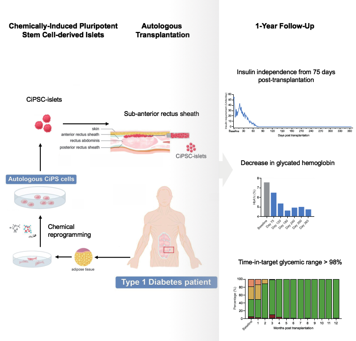 基于CiPS細胞治療1型糖尿病的臨床研究的示意圖和治療效果