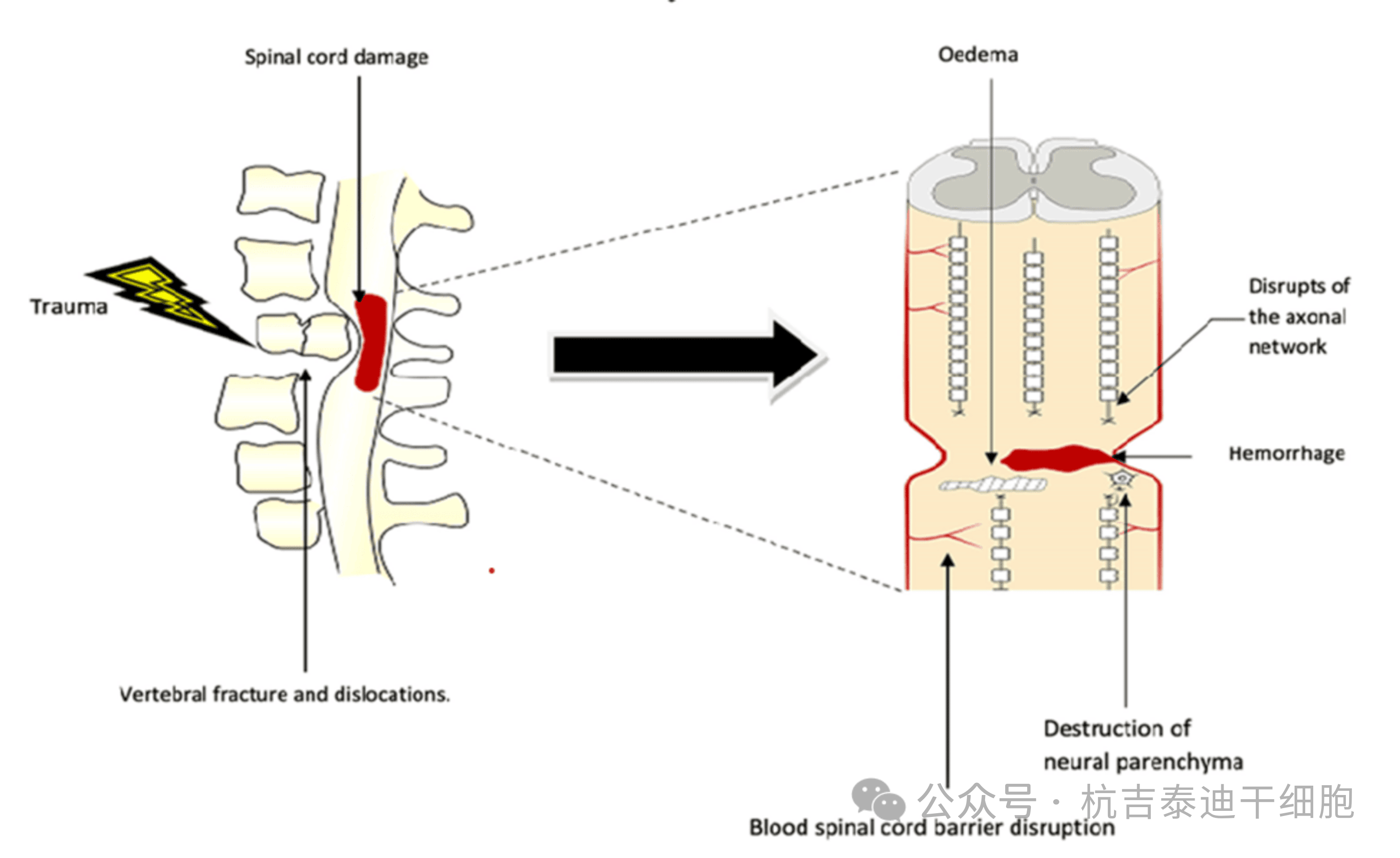 圖1:原發性病變,該圖顯示了創傷的直接影響,包括椎骨骨折、脫位和脊髓損傷導致軸突斷裂、水腫、出血和神經實質破壞 圖1:原發性病變,該圖顯示了創傷的直接影響,包括椎骨骨折、脫位和脊髓損傷導致軸突斷裂、水腫、出血和神經實質破壞