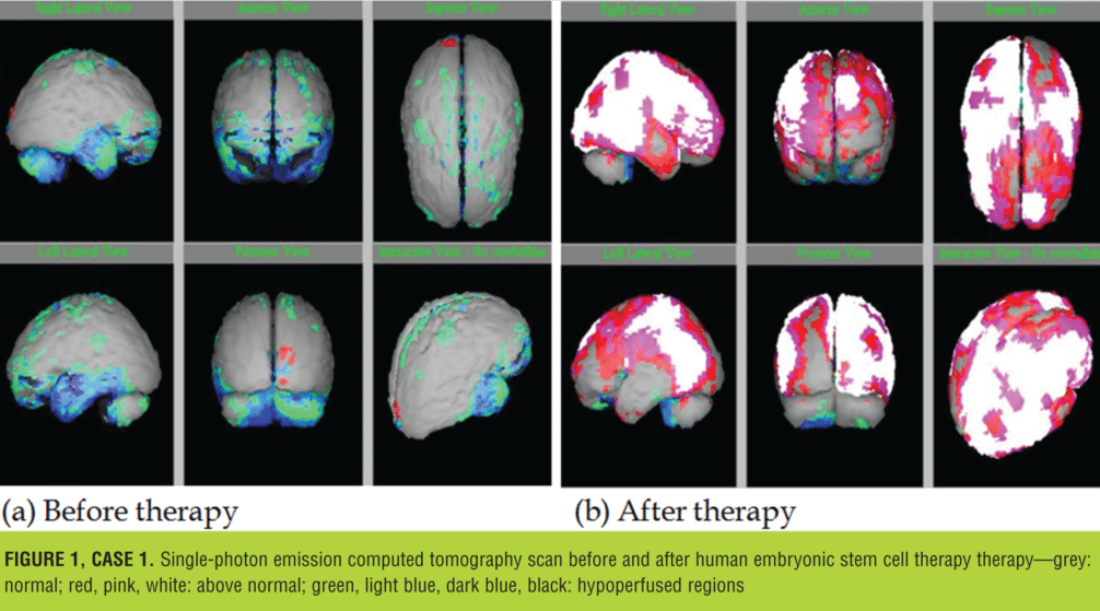 圖 1 為患者第二次治療前后的 SPECT 掃描圖像 圖 1 為患者第二次治療前后的 SPECT 掃描圖像