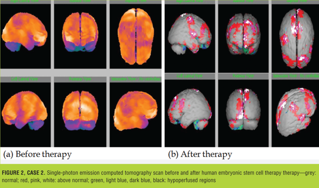 在大腦和小腦區域觀察到的灌注程度顯著降低(圖 2) 在大腦和小腦區域觀察到的灌注程度顯著降低(圖 2)