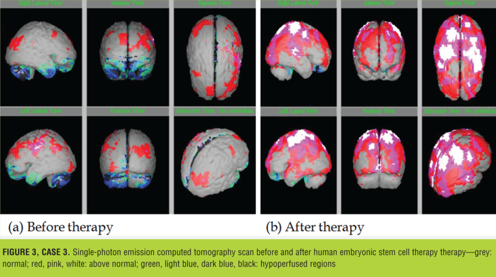 與之前的掃描結果相比,2014 年 1 月 9 日的 SPECT 掃描顯示腦灌注流正常(圖 3) 與之前的掃描結果相比,2014 年 1 月 9 日的 SPECT 掃描顯示腦灌注流正常(圖 3)
