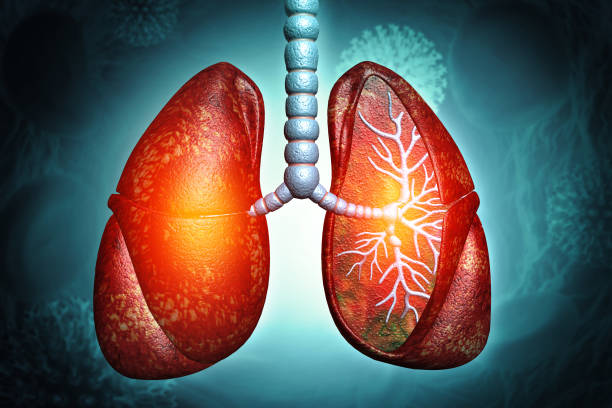 間充質(zhì)干細(xì)胞治療4大類肺部疾病的臨床試驗進(jìn)展及挑戰(zhàn) 間充質(zhì)干細(xì)胞治療4大類肺部疾病的臨床試驗進(jìn)展及挑戰(zhàn)