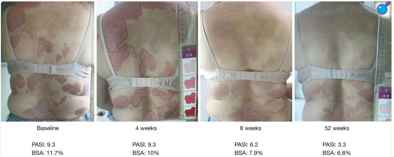 受試者治療前后的代表性皮膚圖像。